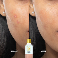 VLCC Clinic Spot Relief - On-Spot Application, Dark Spot Reduction 30 ml