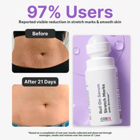 CosIQ Stretch Mark Removal Roll-On Serum 80ml, with Striover, Scar Removal, Uneven Skin Tone, All Skin Types, 60 Days Pack