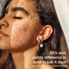 Skog Acne Clarifying Gel 30 ml