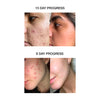 Skog Acne Clarifying Gel 30 ml