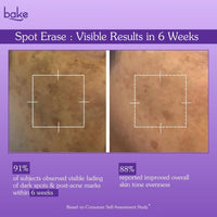 BAKE Spot Erase™ Dark Spot Correcting Serum Cream with Kojic Acid for Post Acne Marks, Melasma & Pigmentation-30g - 4
