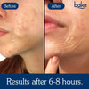 BAKE 2% Salicylic Acid Hydrocolloid Surface XL Acne Patches for Active Blemishes, Blackheads & Whiteheads, Pore Care - 6
