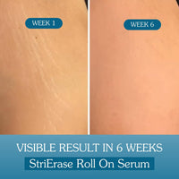 BAKE Stretch Marks Roll-On Serum with 0.5% Encapsulated Bakuchiol – For Stretch Marks, Scars, Skin Firming & Uneven-Looking Skin-50ml - 8