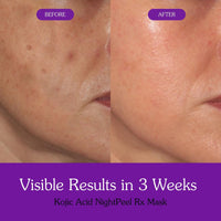 BAKE Night Peel RX Overnight Peel-Off Mask with Kojic Acid and Turmeric for Pigmentation, Tan, Dark Spots - 100ml - 7