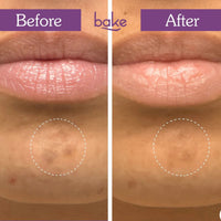 BAKE Spot Erase Micropoint Hydrocolloid Patches for Dark Spots & Post-Acne Marks with 2% Niacinamide and Alpha Arbutin for Spot Correction - 3