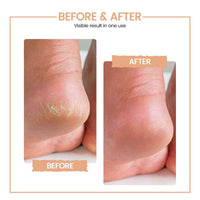 Protouch Bliss Electric Callus Remover For Feet | Rechargeable Pedicure Tool For Dead Skin, Cracked Heels & Hard Skin Removal |Professional Spa Results At Home | 1-Year Doorstep Warranty