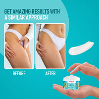 Gynocup Stretch Marks Removal Cream for Pregnancy 50 gm