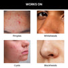 ThriveCo Goodbye Acne Serum 30 ml